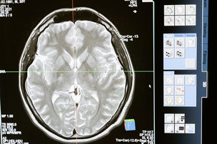 Artificial Intelligence in Dementia Research